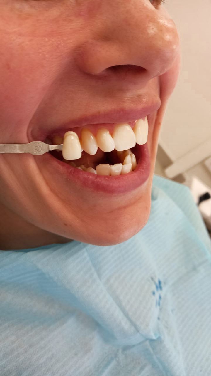Снятие зубных отложений Томск Лесная